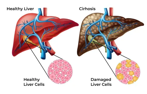 Cirrhosis of The Liver: